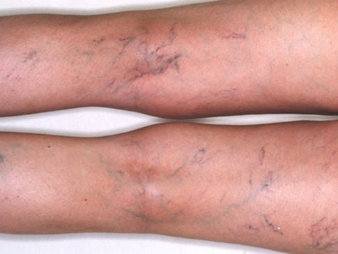 Before SCLEROTHERAPY