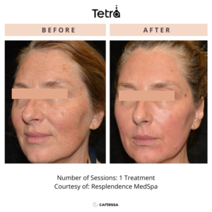 DEKA SmartXide Tetra CO2 Laser before & after